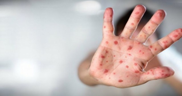 DSÖ: Avrupa'da son 2 haftada maymun çiçeği vakaları üçe katlandı
